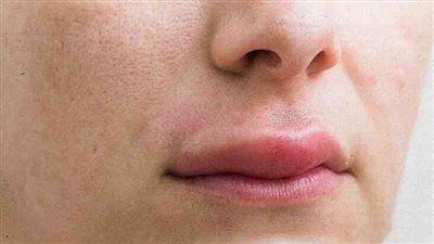 تورم الوجه علامة الإصابة بسرطان الرئة.. خبراء يوضحون 