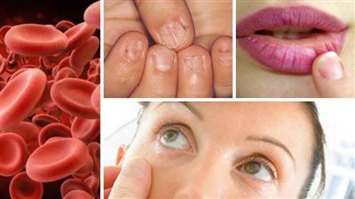 أنواع فقر الدم.. الخبيث ونقص الحديد أبرزها 