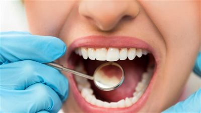 عوامل تؤثر بالسلب على الأسنان وتزيد من التسوس