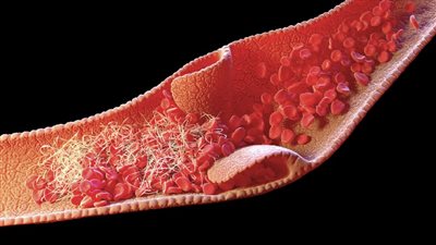 تأثير الجلطة الدموية في الجسم ..عدم القدرة على الحركة أبرزها 