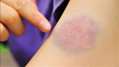 تسبب تجلط الأوردة العميقة.. أسباب الانسداد الرئوي