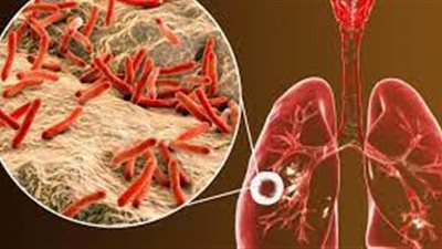 حقيقة تفشي مرض الدرن في مصر عبر النازحين إليها