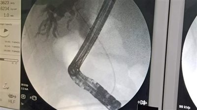 صحة الشرقية: إجراء 9 عمليات مناظير جهاز هضمي بمستشفى منيا القمح