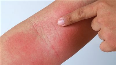 أسباب ظهور الأكزيما.. التهاب الجلد التماسي أشهر الأنواع