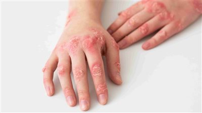 أعراض الأكزيما من الخفيفة إلى الشديدة.. الحكة أبرزها