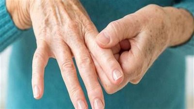 أعراض التهاب المفاصل الصدفي.. تورم أصابع اليدين والقدمين