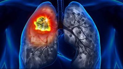 أمراض الرئة الأكثر شيوعًا.. الربو والتهاب الشعب الهوائية أبرزها 