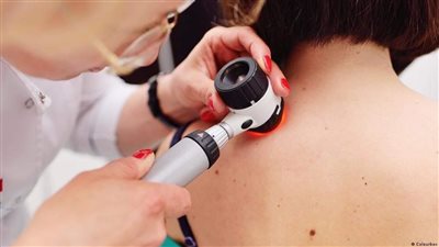 دواء جديد يُحدث ثورة في علاج سرطان الجلد.. خبراء الصحة يزفون بشرى سارة