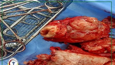 فريق طبى بقنا الجامعى يستأصل رحم سيدة تعانى من أورام ليفية متعددة 