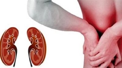 4 مراحل يمر بها الشخص المصاب بالفشل الكلوي.. تعرف عليهم 