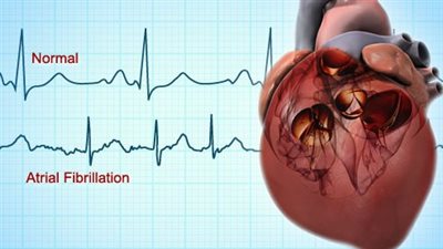 الرجال أكثر عرضة للإصابة بمرض الرجفان الأذيني عن النساء