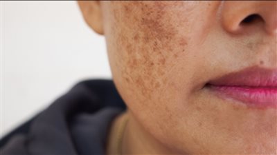 الكلف مرض جلدي يسبب بقع بنية.. أكثر الأشخاص المعرضين له