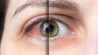 أنواع مرض جفاف العين.. التبخيري والمختلط أبرزها 