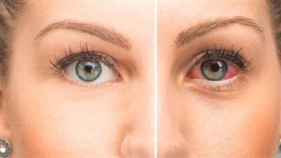 عوامل خطيرة تؤثر على جفاف العين.. أشهر الأسباب 