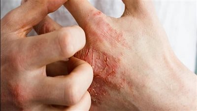 هل يؤدي فقدان الوزن إلى تحسين الأكزيما؟