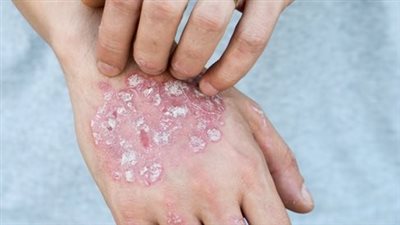 التغييرات الغذائية تساعد على تقليل الإصابة بمرض الصدفية .. دراسة توضح