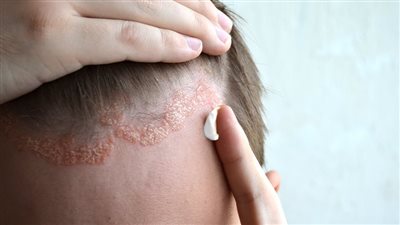 عادات بسيطة تساعد في تقليل الالتهاب المرتبط بالصدفية