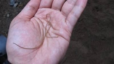 استخراج دودة بطول 8 سم من دماغ مريضة (صور)