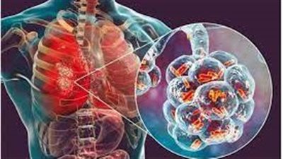 ما هو داء الفيالقة؟.. أودى بحياة 16 شخصًا وأصاب 140 آخرين