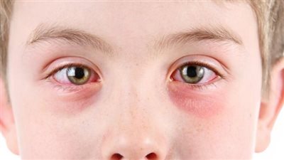 أسباب حدوث عدوى العين المفاجئة