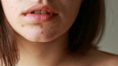 أسباب الإصابة بحب الشباب حول الفم وطرق علاجها