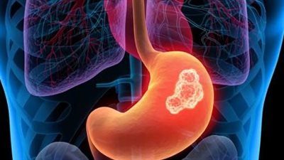 الغذاء الضار أبرز أسباب سرطان المعدة