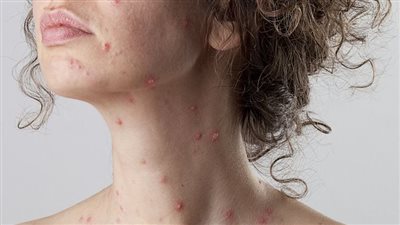 اكتشاف نوع جديد من الفيروس المسبب لجدري الماء في هذه الدولة.. أبرز أعراضه