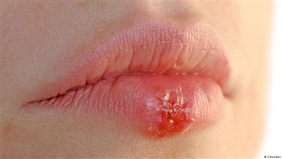 الهربس.. مرض يسبب الالتهابات الجلدية تعرف على أعراضه