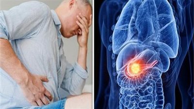 طبيب يوضح الفرق بين أعراض سرطان البنكرياس وأمراض أخرى