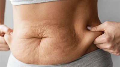 هل هناك إمكانية للتخلص من السيلوليت؟