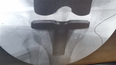 جراحة ناجحة لتغيير مفصل ركبة بمستشفى الزقازيق العام