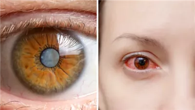 الضمور البقعي.. طبيبة تكشف الأسباب الرئيسية للإصابة بأخطر مرض يهدد العيون 