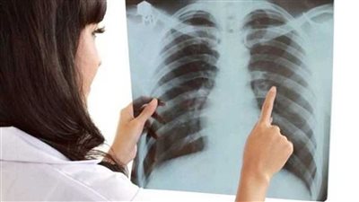 علامتان في العين تشير إلى إصابتك بـ سرطان الرئة 