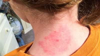 لقاح جديد يعالج مرض لايم.. علماء يزفون بشرى سارة للمرضى