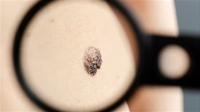 الشامات في الجسم يمكن أن تتحول إلى أورام خبيثة.. طبيبة توضح 