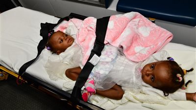 عملية لفصل التوأم السيامي النيجيري 