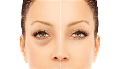 الانتفاخ تحت العينين نتيجة لعدم التوازن الهرموني.. طبيبة تكشف التفاصيل 