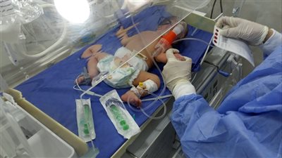 فحص 31 ألف طفل بالمبادرة الرئاسية للكشف المبكر عن الأمراض الوراثية للأطفال المبتسرين بالشرقية