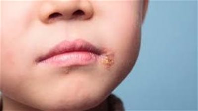 روشتة للوقاية من الهربس بين الأطفال بموسم المدارس