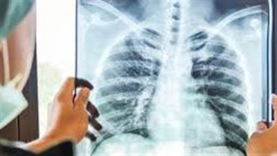 عقب نفي الحكومة ظهور سلالات جديدة .. معلومات عن مرض الدرن وأعراضه