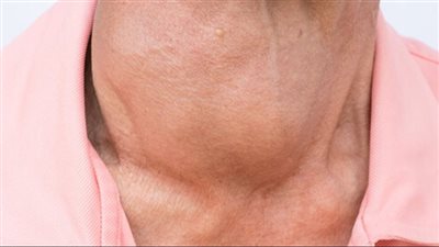 كيف يؤثر فشل هرمونات الغدة الدرقية على الجلد.. طبيبة توضح 10 أعراض