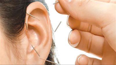 الإبر الصينية.. علاج قديم يخفف آلام الأعصاب ويعيد توازن الجسم