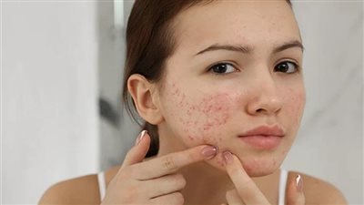 علماء يعدلون جين بكتيريا تخفي حب الشباب في 4 أيام