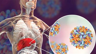 أطباء يوضحون ثلاثة أعراض واضحة لالتهاب الكبد الوبائي 