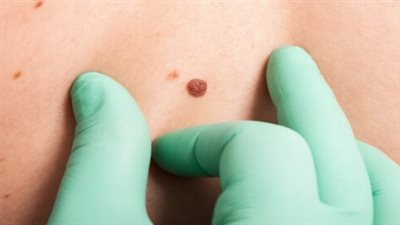 نوع من البكتيريا يمنع الإصابة بسرطان الجلد