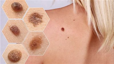  الورم الميلانيني.. نوع من أنواع سرطان الجلد يشكل خطرًا على الإنسان