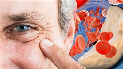 التغييرات الغذائية تقليل نسبة الكوليسترول.. أهم الأعراض 