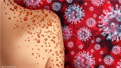 اليابان تعلن أول حالة وفاة بمرض جدري القرود