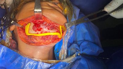 استئصال ورم بالفك بتقنية الطباعة ثلاثية الأبعاد بسوهاج الجامعي 