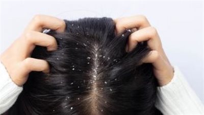 أسباب قشرة الرأس.. عوامل تؤدي إلى زيادتها